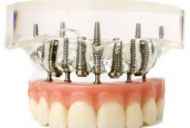 Dentalnih implantata