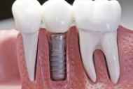 Zubni implantati - "za" i "protiv"