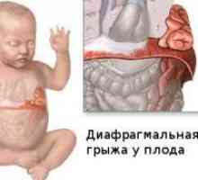 Dijafragmalna hernija u novorođenčadi