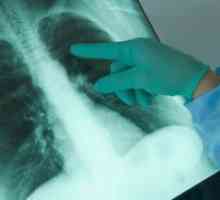 Pleuritis pluća rak
