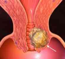 Rak grlića maternice - uzrok
