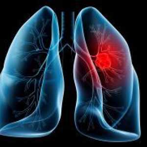 Liječenju karcinoma pluća narodne lekove