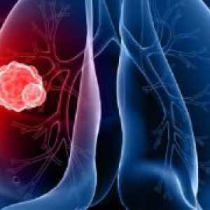 Rak bronhija - Simptomi