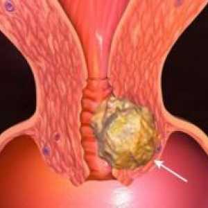 Rak grlića maternice - uzrok